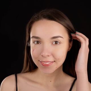 Trattamento delle Cicatrici Cheloidee: Innovazione e Soluzioni Personalizzate a Cuneo