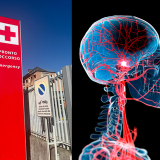 Un farmaco innovativo contro l’ictus ischemico: il tenecteplase arriva in Asst Valle Olona