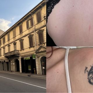 In alto a destra i graffi ieri sera sulla schiena dell'amica, sotto i lividi che Chiara questa mattina ha trovato sulla sua spalla