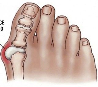 Intervento di correzione dell’alluce valgo: cosa aspettarsi nel post operatorio?