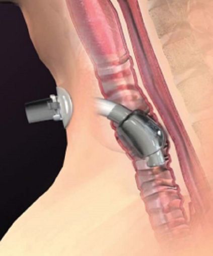 Un équipe specialistica a casa dei pazienti tracheostomizzati Un équipe specialistica a casa dei pazienti tracheostomizzati