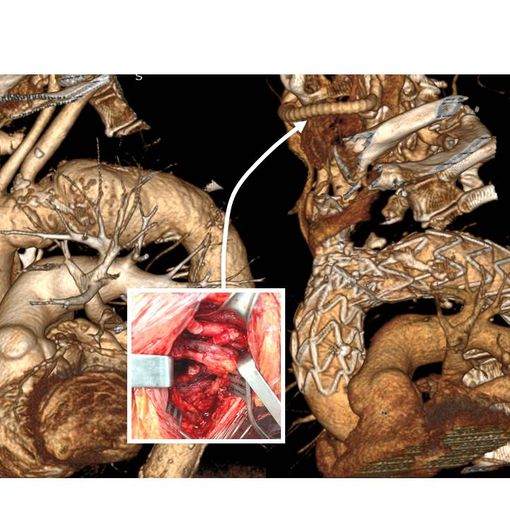 La Chirurgia Vascolare varesina nel ristretto gruppo di quelle che in Italia hanno impiantato un'endoprotesi ramificata