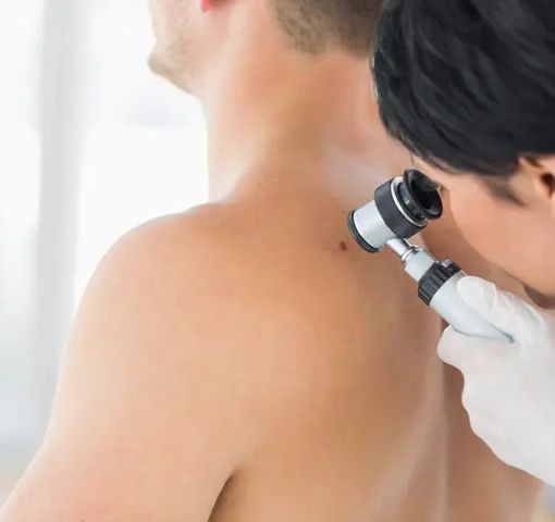 Effetti negativi del sole: invecchiamento precoce e tumori cutanei