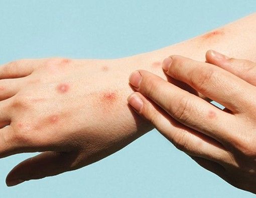 Vaiolo delle scimmie, per il Piemonte gay, trans e bisex a maggior rischio infezione. Ma la circolare era del 2022