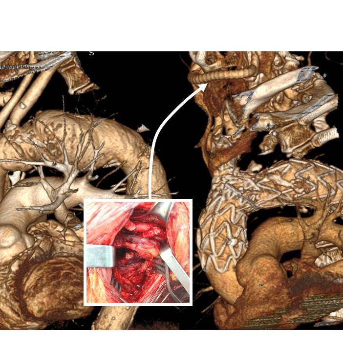 La Chirurgia Vascolare varesina nel ristretto gruppo di quelle che in Italia hanno impiantato un'endoprotesi ramificata