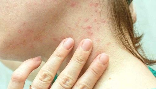 Primo caso di vaiolo delle scimmie in Canton Ticino