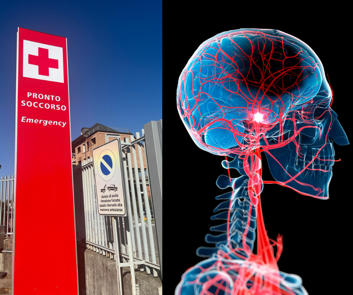 Un farmaco innovativo contro l’ictus ischemico: il tenecteplase arriva in Asst Valle Olona