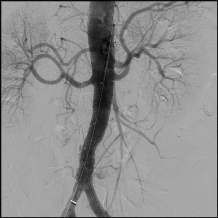 La chirurgia vascolare di Busto all’avanguardia per il trattamento della patologia aortica La chirurgia vascolare di Busto all’avanguardia per il trattamento della patologia aortica