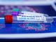 Coronavirus, il punto in provincia: Varese +51, Busto +27, Gallarate +27, Saronno +13