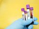 Coronavirus, in provincia di Varese 270 contagi. In Lombardia 3.099 casi e 11 vittime
