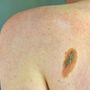 Imi: "Bene legge su prevenzione melanoma, educare i giovani su rischi"