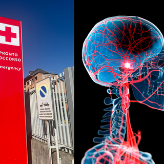 Un farmaco innovativo contro l’ictus ischemico: il tenecteplase arriva in Asst Valle Olona