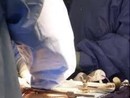 Bimba piuma operata al cuore a Milano, salvata da San Raffaele-San Donato