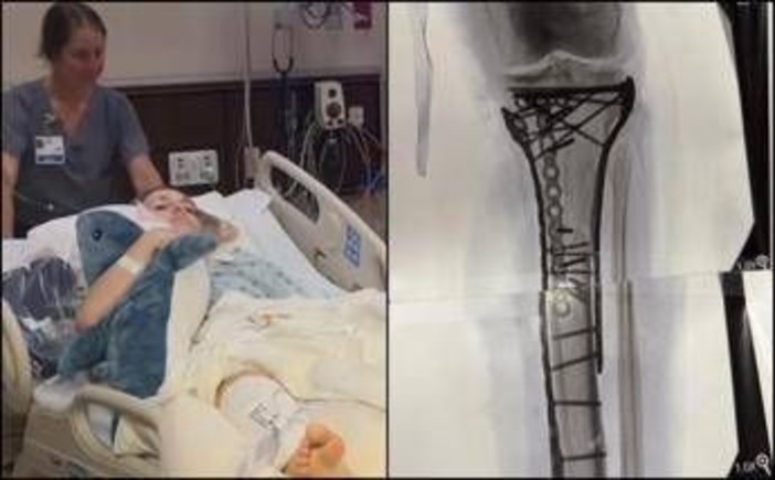 Milano Cortina, Vonn mostra la gamba dopo le operazioni: "Dolore difficile da gestire" Milano Cortina, Vonn mostra la gamba dopo le operazioni: "Dolore difficile da gestire"