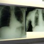 Cancro polmone a piccole cellule, ok Ue a tislelizumab