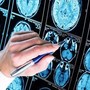Farmaci, ok Ema a donanemab, neurologi: &quot;Svolta in lotta all'Alzheimer&quot;