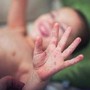 Morbillo, aumentano casi e ricoveri. Bassetti: "In Liguria focolaio senza precedenti, l'Italia rischia gravissima epidemia" Morbillo, aumentano casi e ricoveri. Bassetti: "In Liguria focolaio senza precedenti, l'Italia rischia gravissima epidemia"