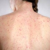 Morbillo, dagli aeroporti Usa alle scuole di Londra: dilagano gli alert Morbillo, dagli aeroporti Usa alle scuole di Londra: dilagano gli alert