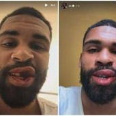 Loftus-Cheek, intervento riuscito alla mascella. E mostra foto dopo scontro in Milan-Parma Loftus-Cheek, intervento riuscito alla mascella. E mostra foto dopo scontro in Milan-Parma