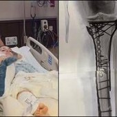 Milano Cortina, Vonn mostra la gamba dopo le operazioni: "Dolore difficile da gestire"