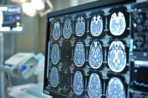 Neoplasie cerebrali, in Italia ogni anno 3mila casi di glioma Neoplasie cerebrali, in Italia ogni anno 3mila casi di glioma