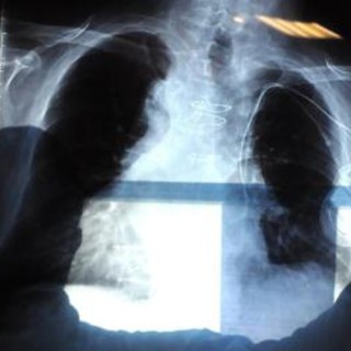 Cancro polmone, nuova terapia orale riduce del 44% il rischio di morte