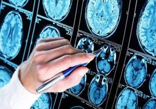 Farmaci, ok Ema a donanemab, neurologi: &quot;Svolta in lotta all'Alzheimer&quot;