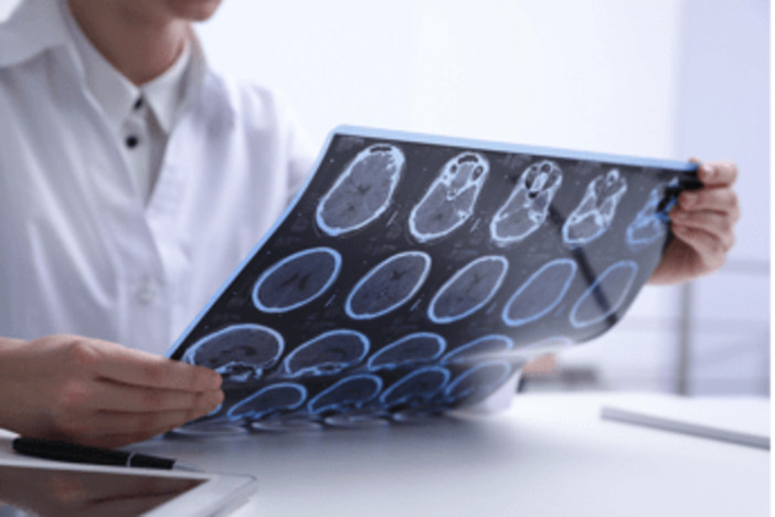 Sclerosi multipla e maternità, neurologa Marfia: &quot;Personalizzare percorso&quot;