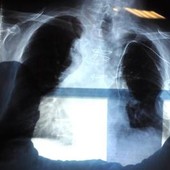 Cancro al polmone aggressivo, combinazione farmaci riduce del 58% rischio morte
