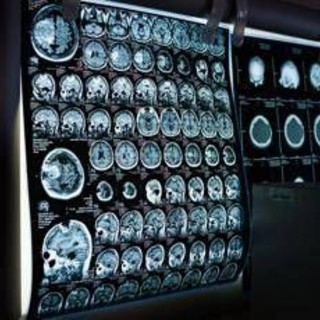 Giornata mondiale delle malattie rare, Sin rafforza impegno per patologie neurologiche