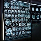 Giornata mondiale delle malattie rare, Sin rafforza impegno per patologie neurologiche