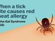Se una zecca rende allergici a carne e latticini, cos'è la sindrome alfa-gal