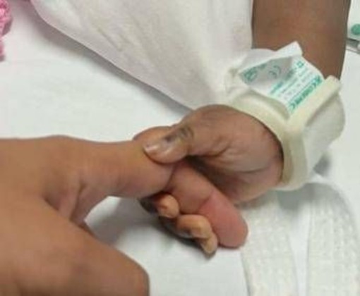 Gemelle siamesi separate al Gaslini di Genova: &quot;Estubate, respirano da sole&quot;