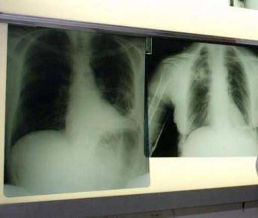 Cancro polmone a piccole cellule, ok Ue a tislelizumab